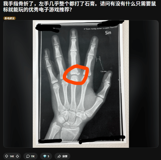 左手骨折也要打!玩家晒X光求助 网友狂推\”单手\”游戏